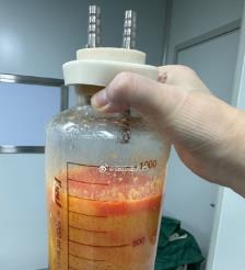 邓州水动力吸脂手术要做多久？